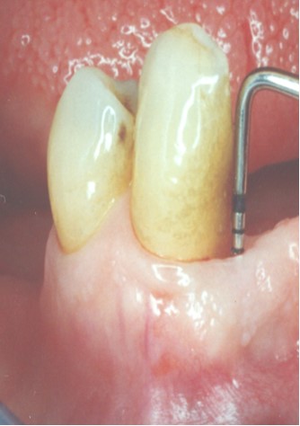 Slika 1. Klinički prikaz uznapredovalog parodontitisa verificiran parodontnom sondom