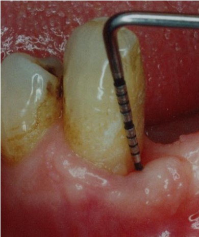 Slika 2. Klinički prikaz zaustavljene progresije bolesti